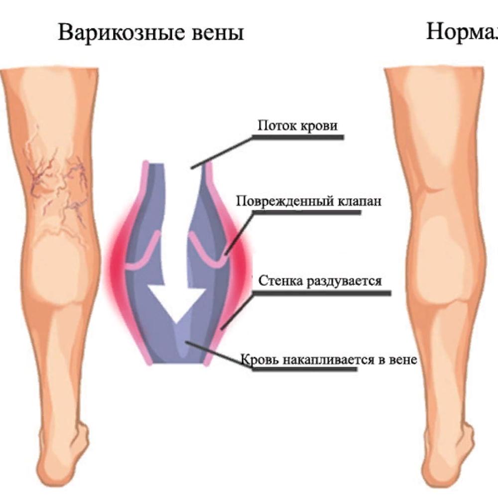 Варикоз Rusmedserv