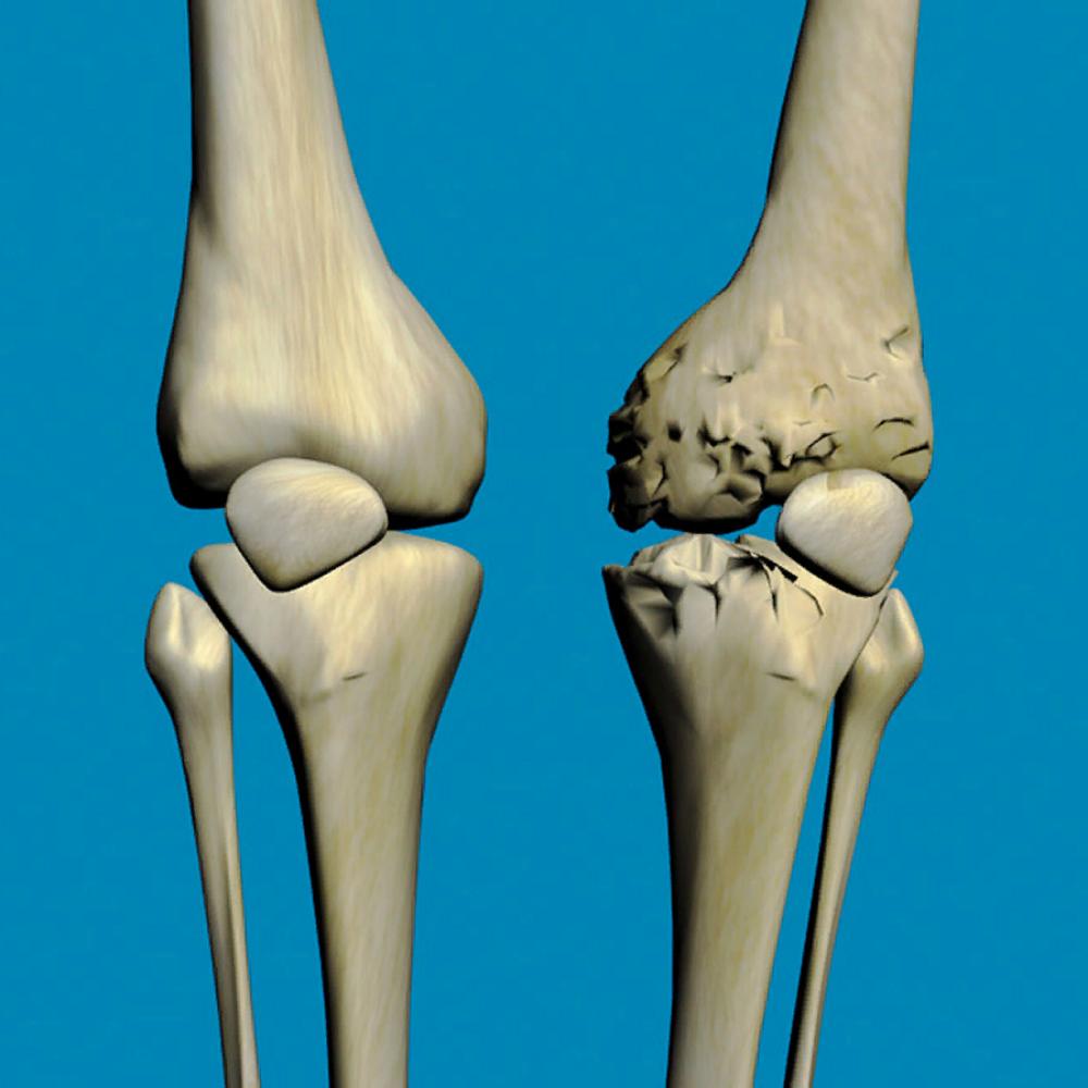 Артроз коленного сустава картинки