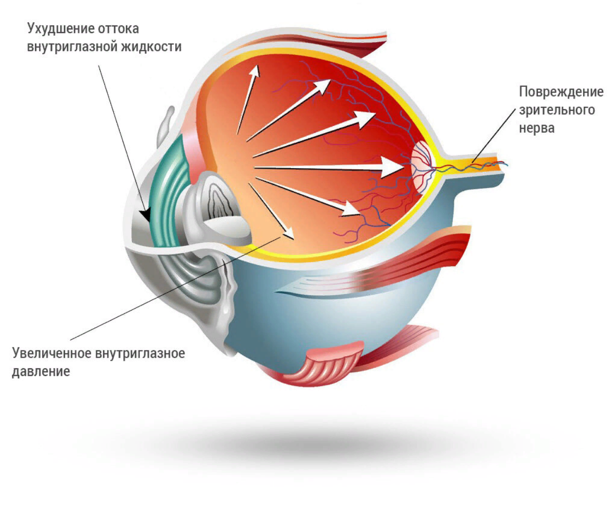 Глаукома что это. Глаукома отток жидкости.