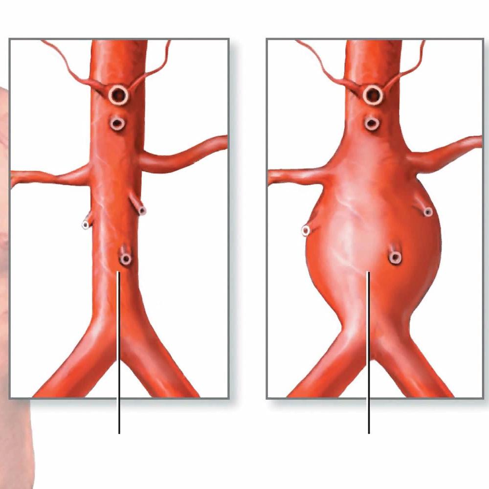 От чего бывает разрыв аорты. Мешотчатая аневризма аорты. Атерокальциноз брюшного отдела аорты. Атеросклеротическая аневризма аорты. Тромбированная аневризма аорты.