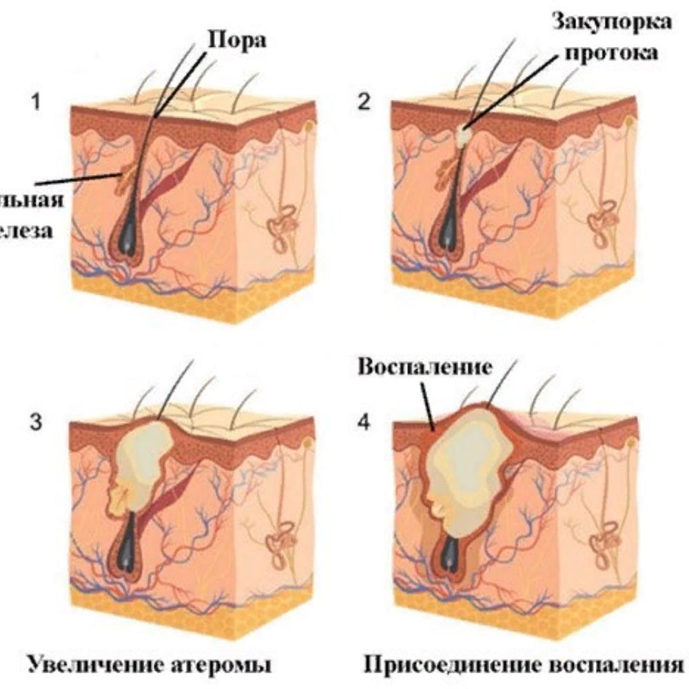 Атерома как выглядит внутри Помощь самоцветов при атероме кожи - купить в Москве, цены в интернет-магазине W